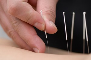 acupuncture clinic near me