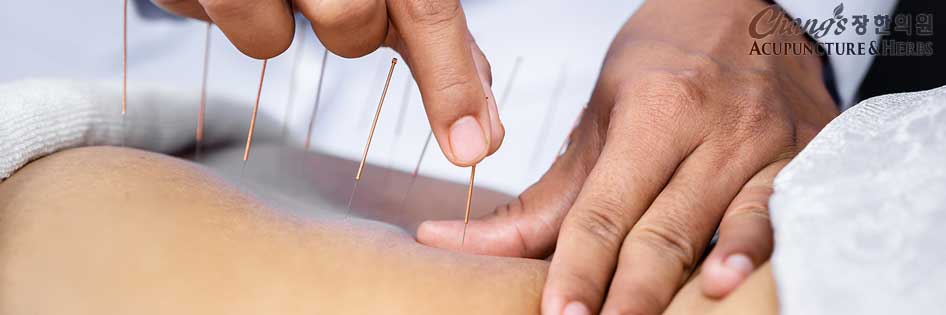 Acupuncture for injury